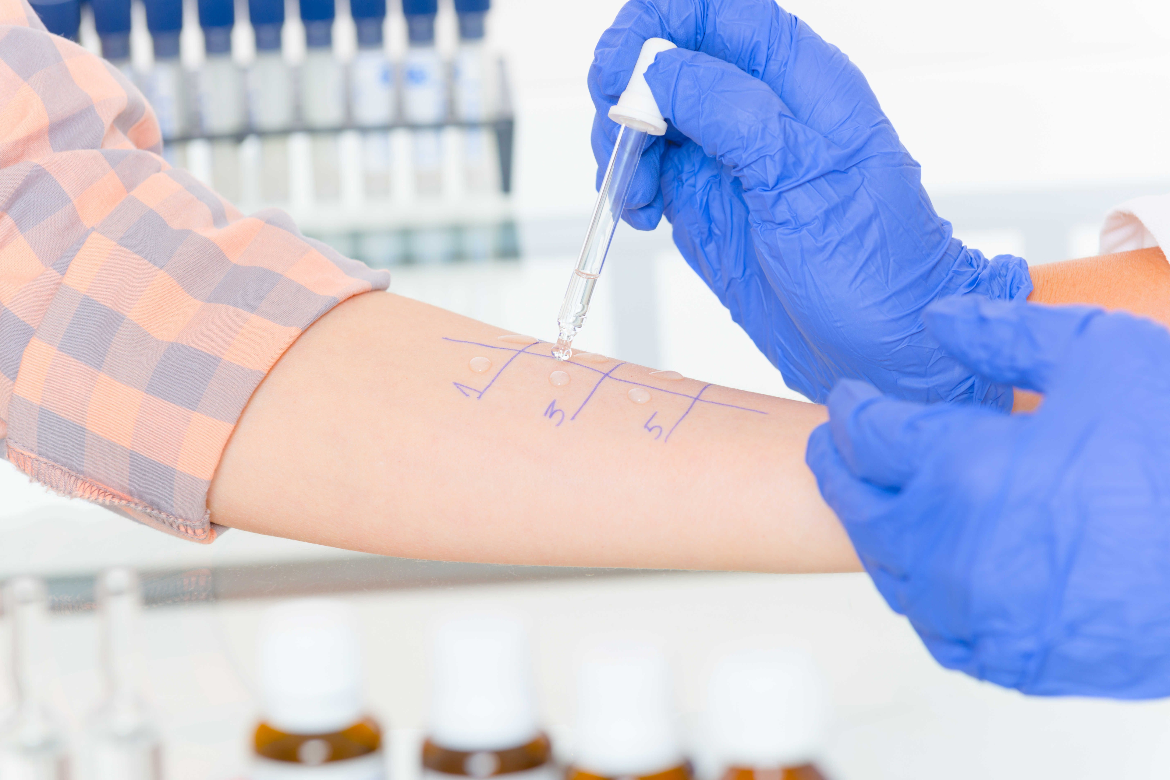 Allergy Diagnosis: Skin Test