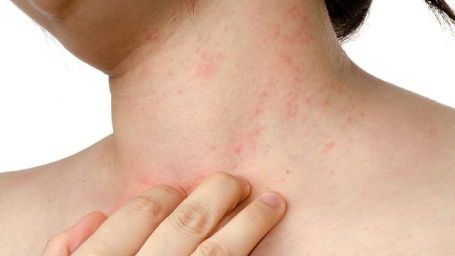 Pilihan Rawatan Psoriasis Bagi Kanak-kanak