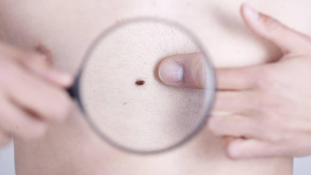 is-a-mole-cancerous