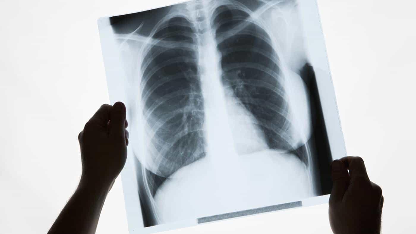 A Spot on the Lung: What Does It Mean?