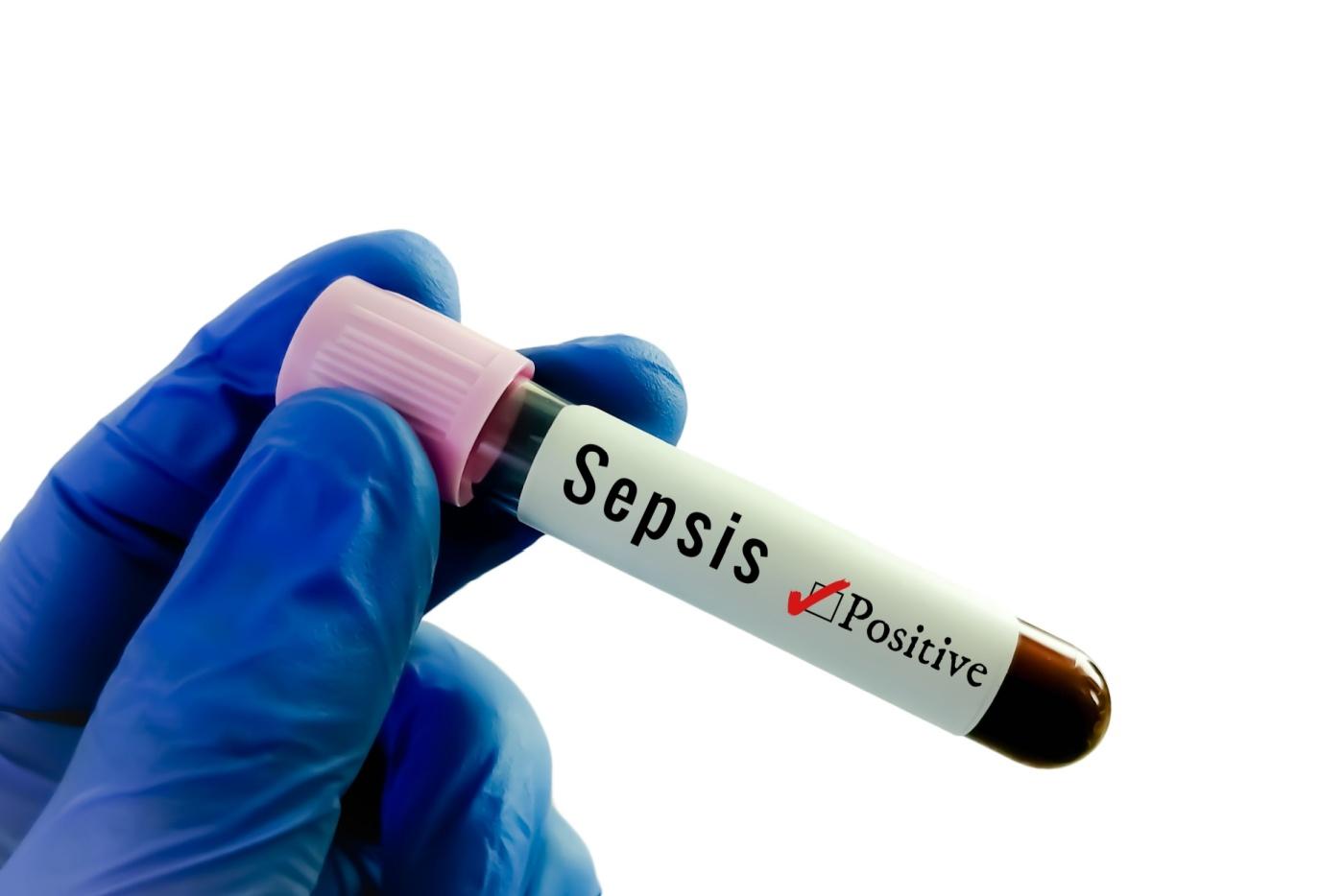 Apa Itu Sepsis? Ini Simptom, Faktor Risiko dan Punca Berlakunya Sepsis!