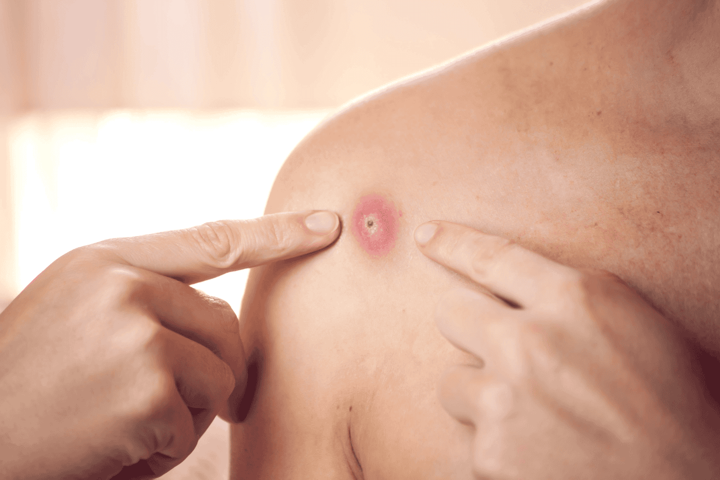 Kenapa Badan Selalu Naik Bisul? Ini 6 Punca Bisul Sebenarnya!