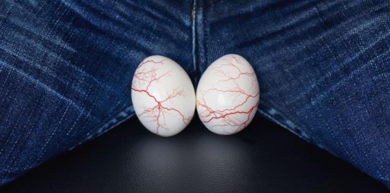 Penyakit Varikosel, Apa Sebenarnya Yang Akan Berlaku Kepada Testis Anda Ketika Ini?