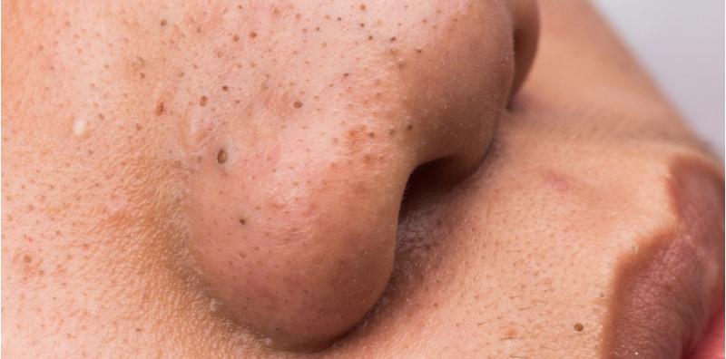 Bintik Hitam Di Kulit Muka (Blackhead), Kenali Simptom, Punca & Cara Rawat!