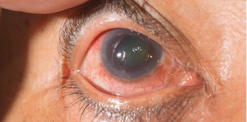 Glaukoma Boleh Sebabkan Buta! Ini Simptom, Risiko & Rawatannya