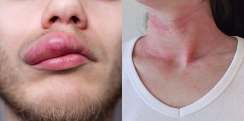 Tanda Alergi Yang Muncul Tak Boleh Dibuat Main, Komplikasi Teruk Boleh Membawa MAUT!