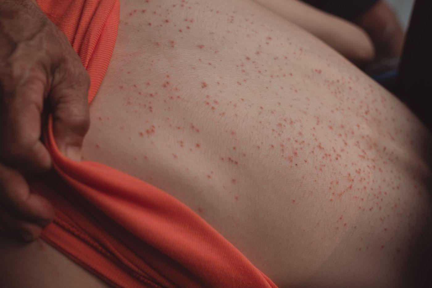 Awas! Ini Simptom Leukemia Yang Boleh Terjadi Pada Anda!