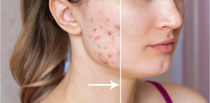 6 Makanan Ini Boleh Bantu SINGKIRKAN Parut Jerawat, Cubalah!