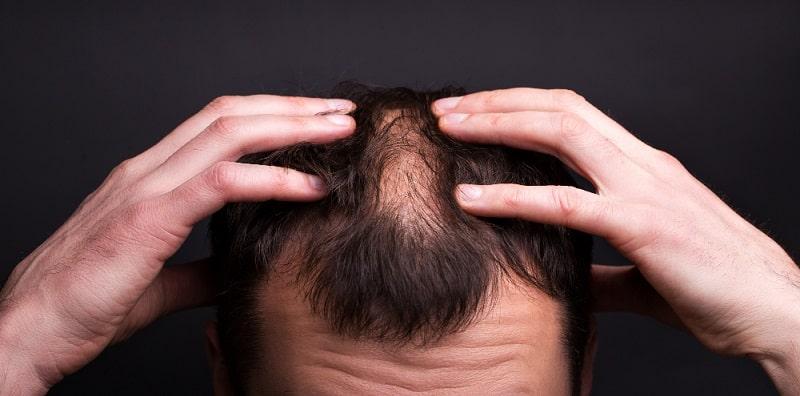 5 Perkara Penderita Rambut Gugur Boleh Cuba! Tapi, Kena Tahu Punca Dulu?