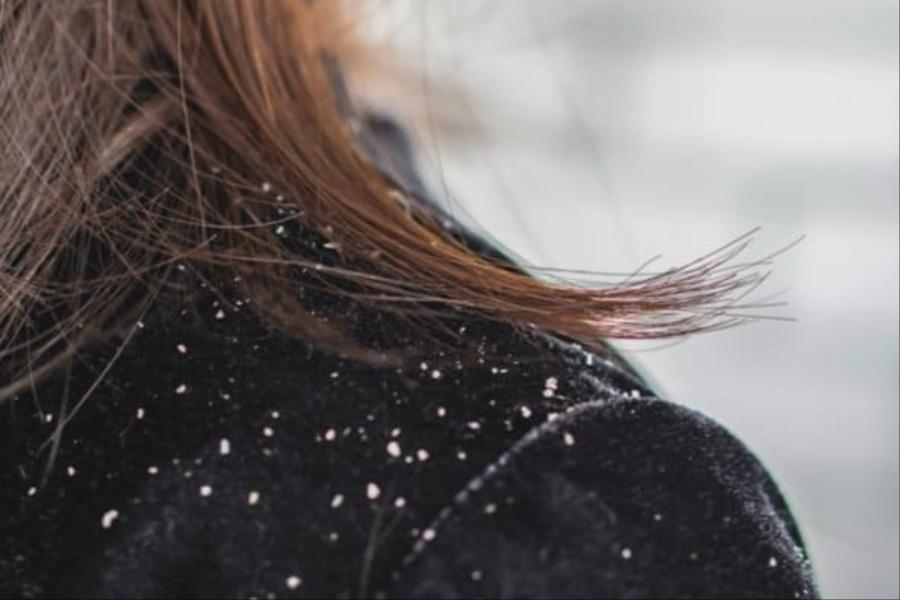 PENTING, 4 Punca Ini Dalang Sebenar Di Sebalik Masalah Rambut Naik Kelemumur!