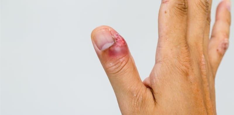 Paronikia, Masalah Pada Kuku Tangan & Kaki Yang Boleh Memudaratkan Jari?