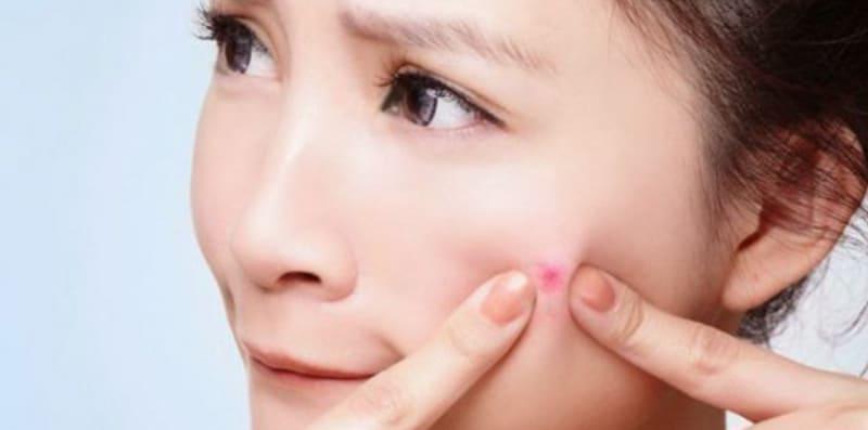 Fakta Menarik Tentang Jerawat @ Akne, Saintis Pun Masih Kurang Pasti Punca?