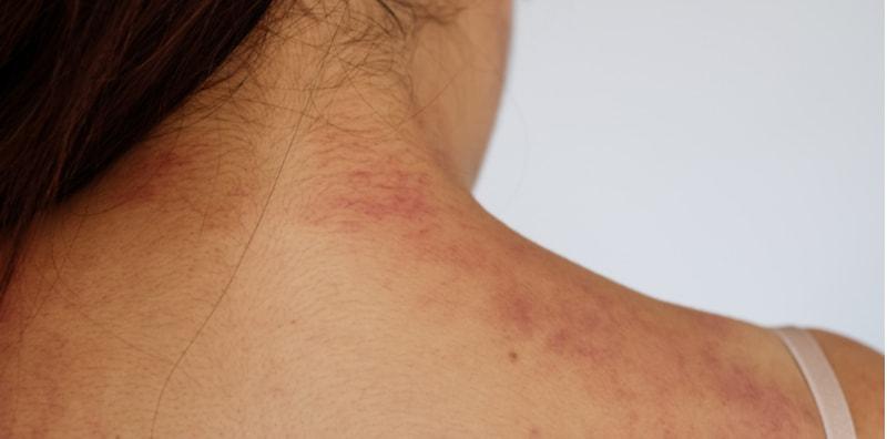 Bagaimana Nak Tahu Kita Ada Alahan Ubat? Ini Info Lengkap Tentangnya