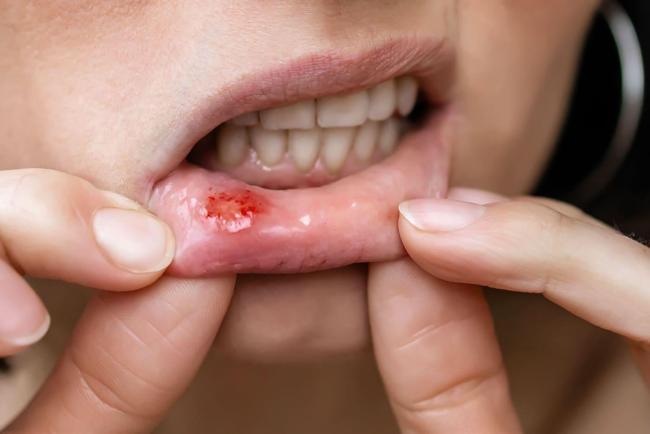 Ulser Mulut Asyik Berulang? Ini 5 Punca Sebenar, Bukan Sekadar Kurang Air!