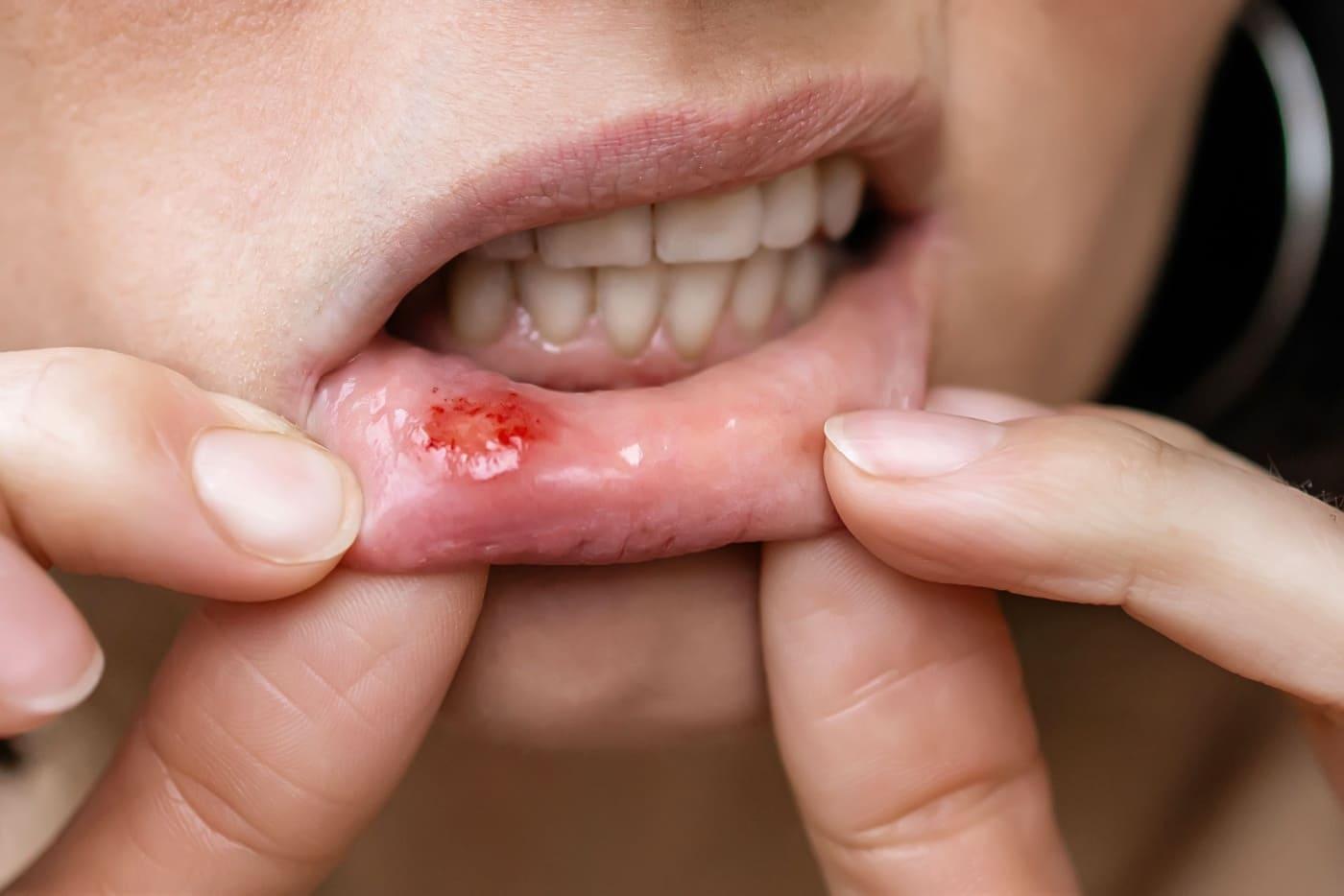 5-punca-biasa-ulser-mulut