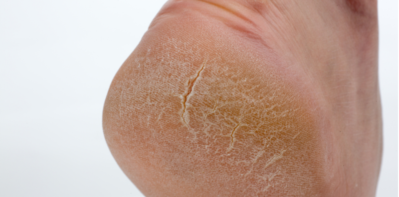 Kulit Kaki Tidak Cantik Macam Dulu? Cuba Tip Merawat Kulit Merekah Ini, Dapat Balik Kaki Menawan!