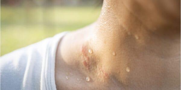 hipoglicemia diabetes