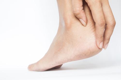 Rawatan Semula Jadi Bagi Tumit Pecah