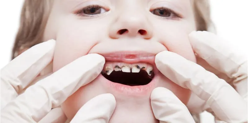 Botol Susu Punca Karies Pada Gigi Anak, Ini 8 Cara Untuk Mencegah Kerosakan Gigi Si Kecil