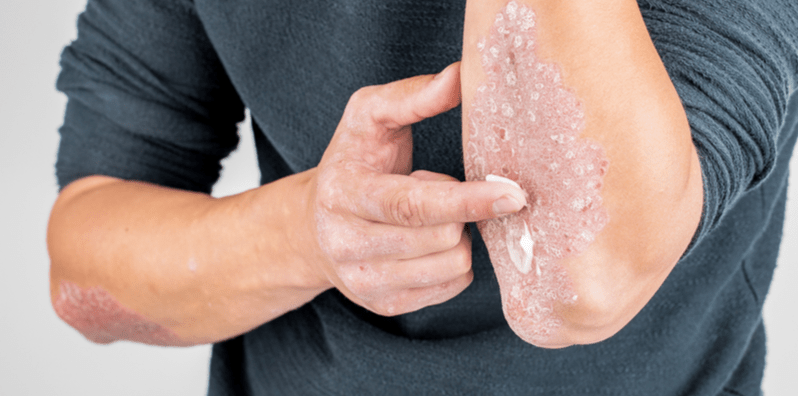 Cuba 4 Cara Mudah & Efektif Ini Untuk Merawat Psoriasis Secara Semula Jadi!