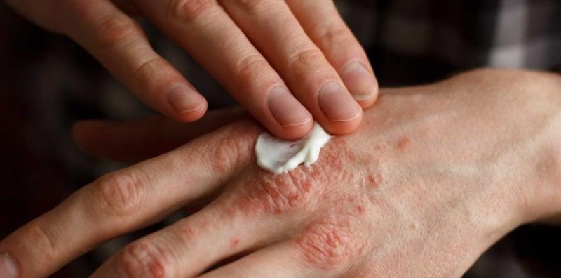 Penting! Sila Elak Dari Amal Diet Begini Jika Anda Ada Masalah Kulit Psoriasis!