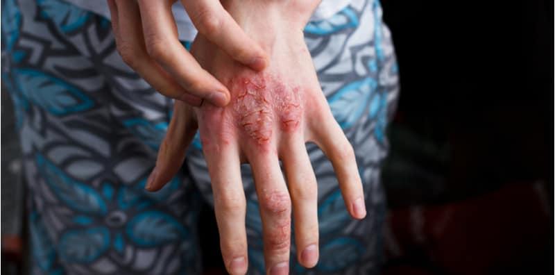 Masalah Kulit Psoriasis Atau Ekzema? Ini Cara Untuk Membezakannya, WAJIB Ambil Tahu!