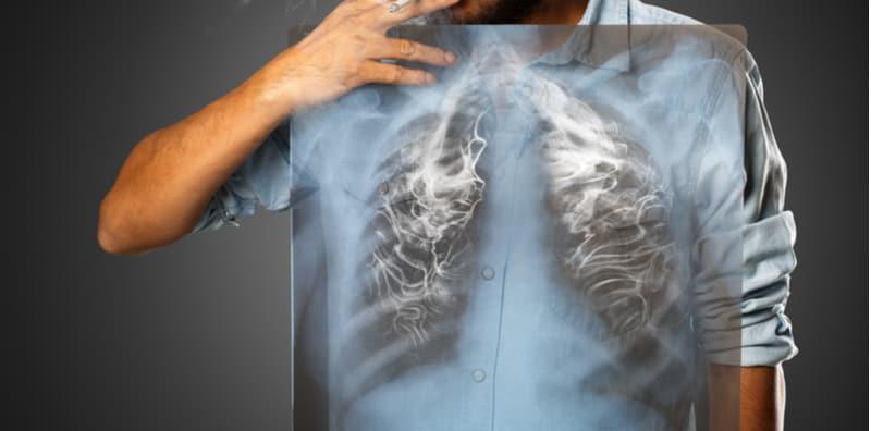 Ramai Belum Sedar Tentang Bahaya Kanser Paru-Paru, Itu Sebab Gaya Hidup Merokok Masih TINGGI!