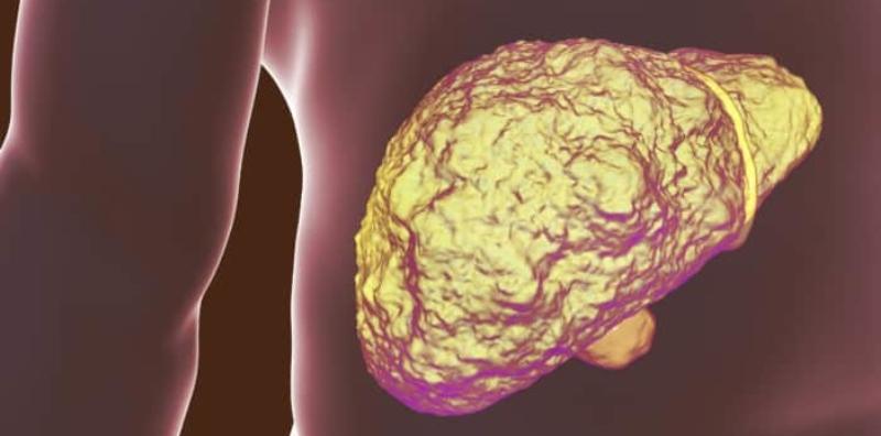 Pernah Dengar Tentang Penyakit Sirosis Hati? Ini Penerangannya Lebih Lanjut!