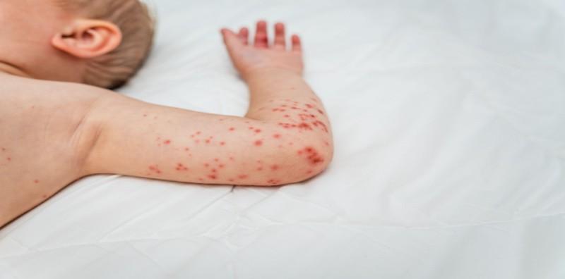 Penyakit HFMD dan Cacar Air: Apa Perbezaannya?