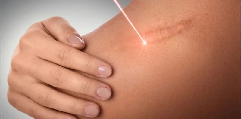 Keloid, Sejenis Parut Yang Boleh Merebak & Membesar? Jom Baca Lebih Lanjut!