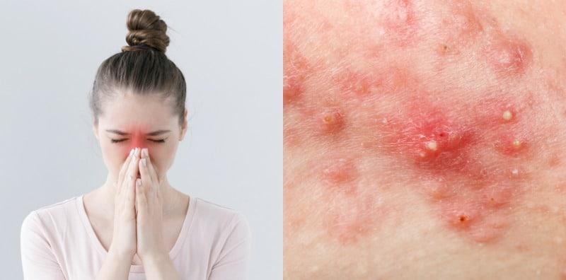 Patutlah Individu Dengan Resdung Selalu Naik Banyak Jerawat, Ini 3 Kaitannya!
