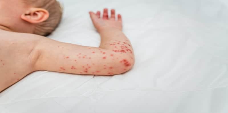 Berkesan Ke Rawat HFMD Dengan Ubat Spray Mulut? Ini Penjelasan KKM