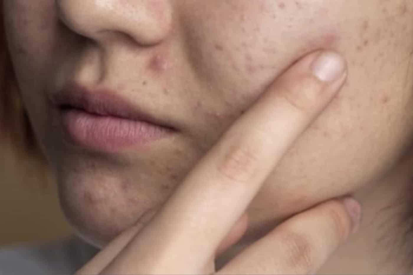 Hilangkan Parut Jerawat Di Muka Dengan 6 Cara Ini, Semua Bahan Senang Dapat!