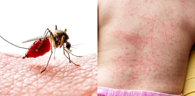 Ini KOMPLIKASI Demam Denggi, Boleh Jadi Punca Nyawa Melayang!