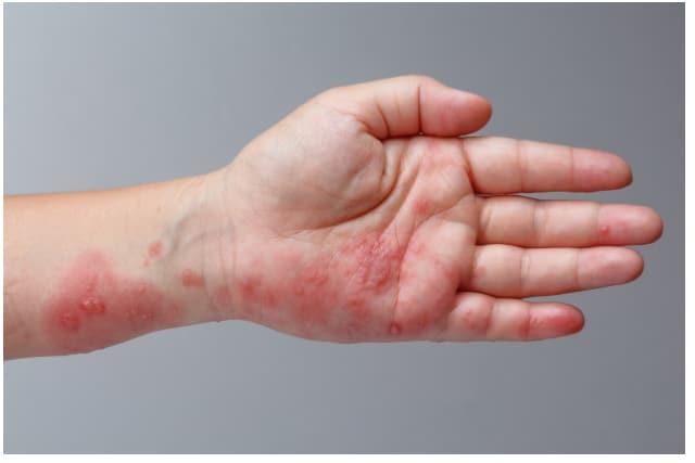 penyakit kulit kanak kanak