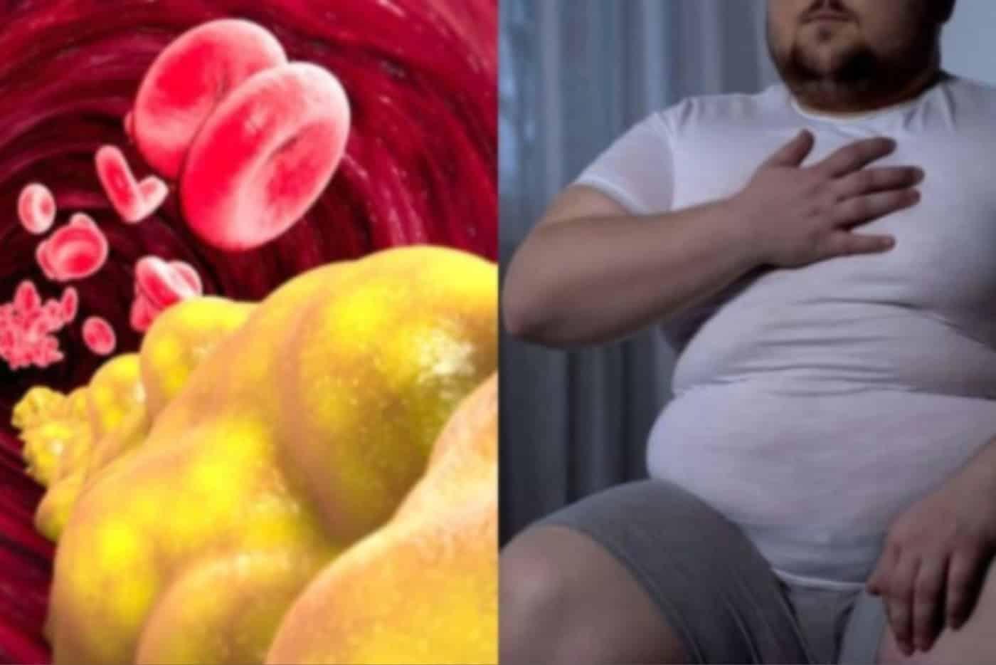 Ada Masalah Kolesterol Tinggi? Ini 5 Penyakit Yang Anda Akan Dapat Kalau Tak Kawal!