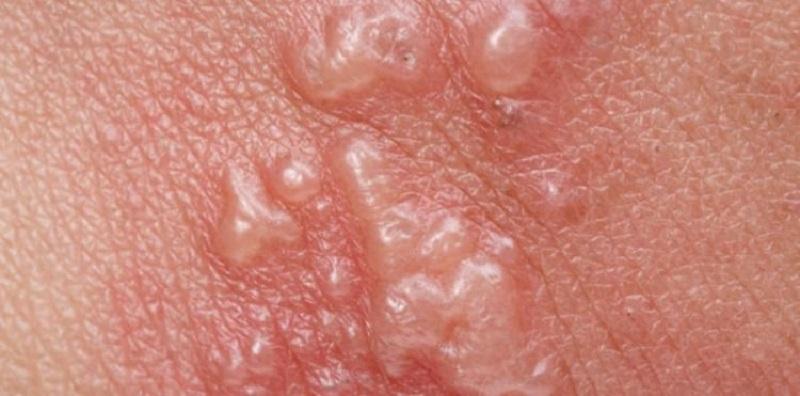 Kayap (Zoster) pada Kanak-kanak