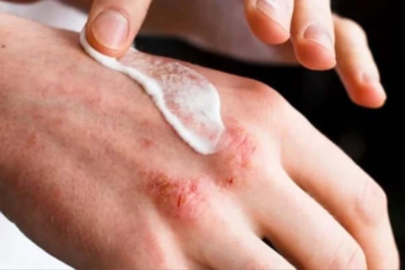 Ada Masalah Ekzema Yang Pedih? 5 Bahan Rawatan Semula Jadi Ini Boleh Bantu Atasinya!
