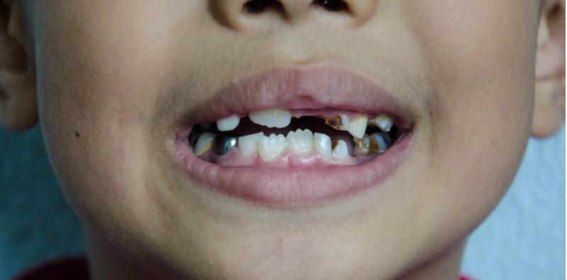 Gigi Anak Berkarat Dan Rongak, Ini 5 Cara Mencegah Kerosakan Gigi Kanak-Kanak