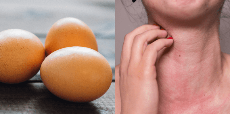 Jenis-jenis Alahan Makanan dan Panduan Pemakanan Khas