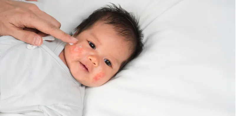 Sedih Lihat Kulit Bayi Alami Ekzema Yang Kronik, Kenali Lebih Mendalam Apakah Puncanya!