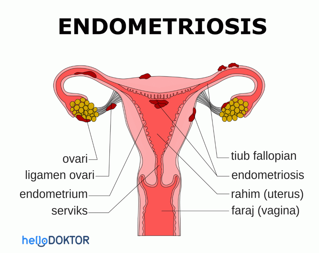 apa itu endometriosis