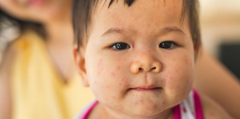 Roseola, Jangkitan Yang Biasa Berlaku Kepada Kanak-Kanak & Menyebabkan Ruam!