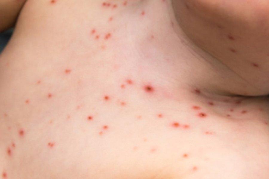 Tumbuh Bintik Merah Di Badan, Sebab Cacar Air Atau Campak? Ini Bezanya!
