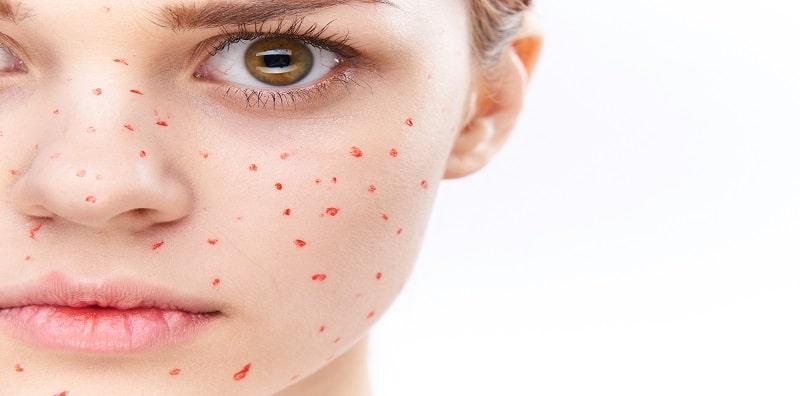 Eh, Betul Ke Orang Dewasa Pun Boleh Kena Chicken Pox? Kenal Pasti Simptomnya!