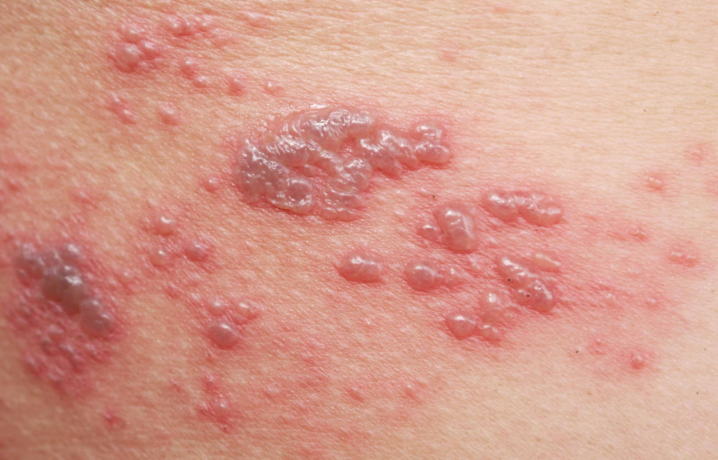 Kayap: Kesinambungan daripada Chickenpox