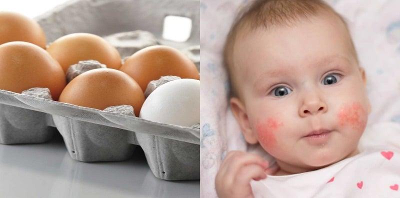 Ini Tanda Jika Anak Anda Alami Alahan Telur, Bahaya Jika Tersalah Makan!