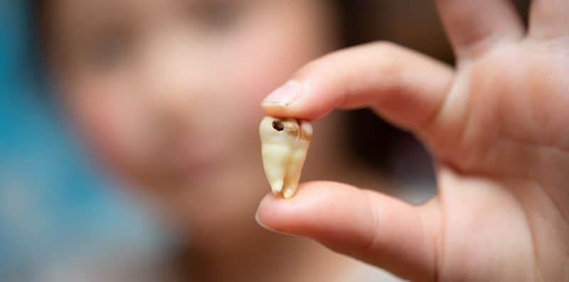 8 Punca Ini Penyebab Gigi Anda Rosak & Berkulat