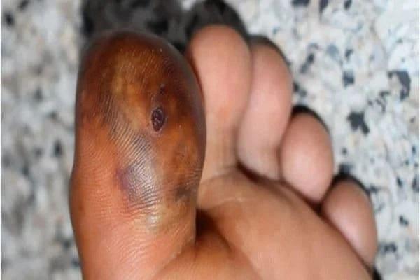 punca kaki bengkak