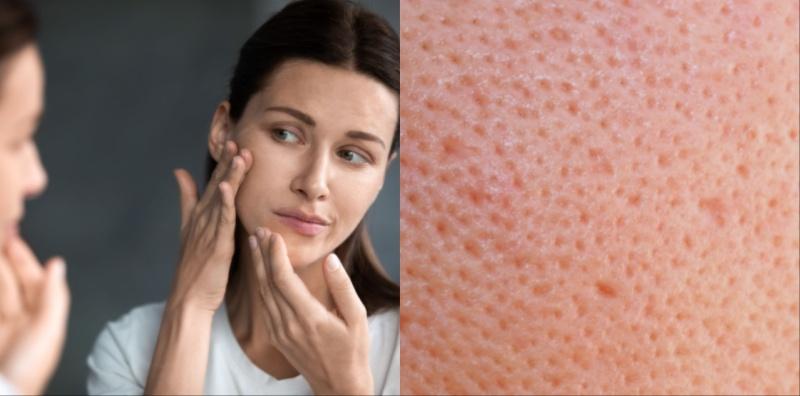 Masalah Liang Pori Besar